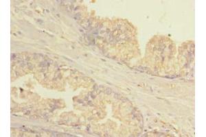 Immunohistochemistry of paraffin-embedded human prostate cancer using ABIN7154781 at dilution of 1:100 (GBP5 anticorps  (AA 321-500))