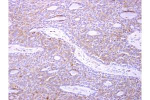 IHC-P Image p41-ARCb antibody [N1], N-term detects p41-ARCb protein at cytosol on human lung carcinoma by immunohistochemical analysis. (ARPC1B anticorps  (N-Term))