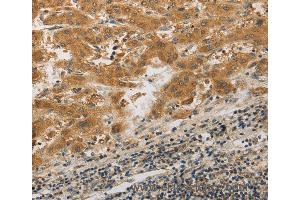 Immunohistochemistry of Human liver cancer using PIBF1 Polyclonal Antibody at dilution of 1:20 (PIBF1 anticorps)