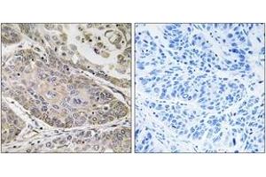 Immunohistochemistry analysis of paraffin-embedded human lung carcinoma, using PLA2G4E Antibody.
