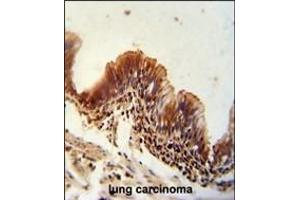 TXNDC6 antibody (Center) (ABIN654968 and ABIN2844606) immunohistochemistry analysis in formalin fixed and paraffin embedded human lung carcinoma followed by peroxidase conjugation of the secondary antibody and DAB staining.