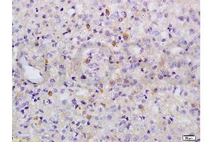 Formalin-fixed and paraffin embedded human liver carcinoma labeled with Anti-Phospho-Wee1(Ser642) Polyclonal Antibody, Unconjugated (ABIN746873) at 1:200 followed by conjugation to the secondary antibody and DAB (WEE1 anticorps  (pSer642))