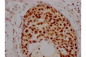 IHC image of ABIN7127538 diluted at 1:100 and staining in paraffin-embedded human breast cancer performed on a Leica BondTM system.