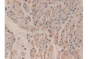 Detection of CASP3 in Human Esophagus cancer Tissue using Polyclonal Antibody to Caspase 3 (CASP3)