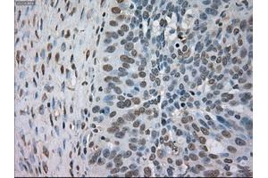 Immunohistochemical staining of paraffin-embedded Adenocarcinoma of colon tissue using anti-BUB1Bmouse monoclonal antibody. (BUB1B anticorps)