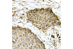 Immunohistochemistry of paraffin-embedded Human esophageal cancer using GST3/GSTP1 antibody (ABIN7267448) at dilution of 1:100 (40x lens). (GSTP1 anticorps)