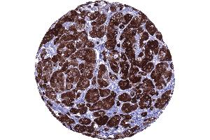 Strong inhibin alpha immunostaining in all cells of an adrenocortical adenoma