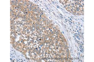 Immunohistochemistry of Human gastric cancer using PAPSS1 Polyclonal Antibody at dilution of 1:40 (PAPSS1 anticorps)