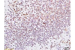 Formalin-fixed and paraffin embedded human gastric carcinoma labeled with Anti CENPF Polyclonal Antibody, Unconjugated (ABIN872667) at 1:200 followed by conjugation to the secondary antibody and DAB staining. (CENPF anticorps  (AA 551-650))
