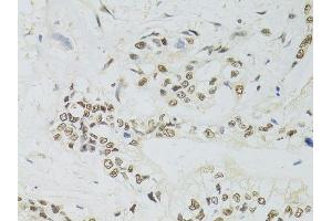 Immunohistochemistry of paraffin-embedded human gastric cancer using PPP4C antibody.