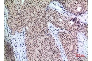 Immunohistochemistry (IHC) analysis of paraffin-embedded Human Mammary Cancer, antibody was diluted at 1:100. (P57 (Ser24) anticorps)