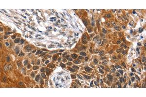 Immunohistochemistry of paraffin-embedded Human esophagus cancer tissue using HOXB1 Polyclonal Antibody at dilution 1:40 (HOXB1 anticorps)
