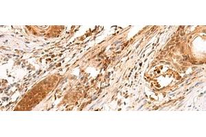Immunohistochemistry of paraffin-embedded Human esophagus cancer tissue using SCAND1 Polyclonal Antibody at dilution of 1:90(x200) (SCAND1 anticorps)