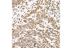 Immunohistochemistry of paraffin-embedded human colon carcinoma using Phospho-ST-Y705 Rabbit mAb (ABIN6135325, ABIN6136266, ABIN6136267 and ABIN7101883) at dilution of 1:100 (40x lens).