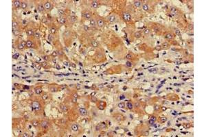 Immunohistochemistry of paraffin-embedded human liver cancer using ABIN7153517 at dilution of 1:100 (GABARAPL1 anticorps  (AA 1-117))