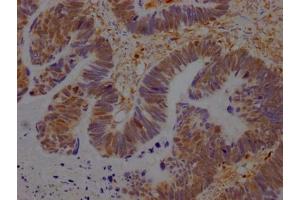 IHC image of ABIN7127524 diluted at 1:100 and staining in paraffin-embedded human ovarian cancer performed on a Leica BondTM system.