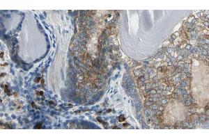 ABIN6276618 at 1/100 staining Human prostate tissue by IHC-P. (Adenylate Kinase 1 anticorps  (Internal Region))