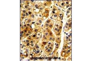 Formalin-fixed and paraffin-embedded human hepatocarcinoma with NFKBIA Antibody (S32/36 ), which was peroxidase-conjugated to the secondary antibody, followed by DAB staining.