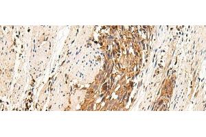 Immunohistochemistry of paraffin-embedded Human esophagus cancer tissue using MRGPRD Polyclonal Antibody at dilution of 1:25(x200) (MRGPRD anticorps)