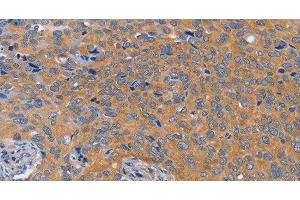 Immunohistochemistry of paraffin-embedded Human cervical cancer tissue using BOD1 Polyclonal Antibody at dilution 1:60 (BOD1 anticorps)