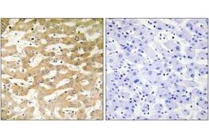 Immunohistochemistry analysis of paraffin-embedded human liver carcinoma tissue, using FADD Antibody. (FADD anticorps  (AA 101-150))