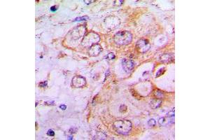 Immunohistochemical analysis of PFKFB2 staining in human lung cancer formalin fixed paraffin embedded tissue section.