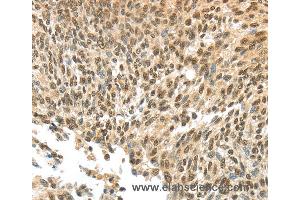 Immunohistochemistry of Human thyroid cancer using APOL6 Polyclonal Antibody at dilution of 1:60 (APOL6 anticorps)