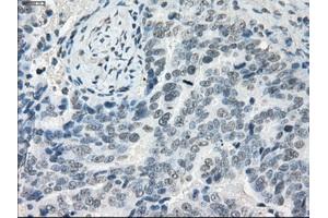 Immunohistochemical staining of paraffin-embedded Adenocarcinoma of colon tissue using anti-LTA4H mouse monoclonal antibody. (LTA4H anticorps)