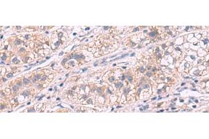 Immunohistochemistry of paraffin-embedded Human liver cancer tissue using G6PC Polyclonal Antibody at dilution of 1:50(x200) (G6PC anticorps)