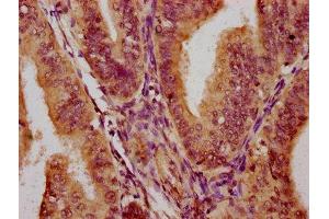 IHC image of ABIN7164590 diluted at 1:300 and staining in paraffin-embedded human endometrial cancer performed on a Leica BondTM system.