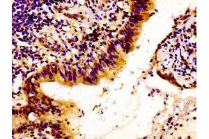 Immunohistochemistry of paraffin-embedded human lung cancer using ABIN7157878 at dilution of 1:100 (Laminin beta 1 anticorps  (AA 523-661))