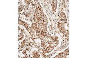 Immunohistochemical analysis of paraffin-embedded Human breast carcinoma tissue using (ABIN6243695 and ABIN6578909) performed on the Leica® BOND RXm.
