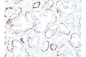 Formalin-fixed, paraffin-embedded human Prostate Carcinoma stained with Cytokeratin, HMW Mouse Monoclonal Antibody (34BE12). (Cytokeratin 2 anticorps)