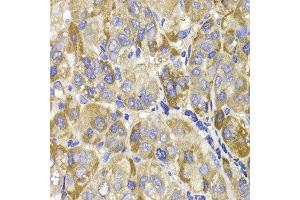 Immunohistochemistry of paraffin-embedded liver cancer using MAGED1 antibody at dilution of 1:100 (x400 lens). (MAGED1 anticorps)