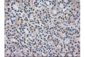 Immunohistochemical staining of paraffin-embedded Carcinoma of kidney tissue using anti-CTAG1Bmouse monoclonal antibody. (CTAG1B anticorps)