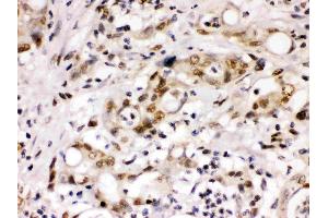 Cyclin T1 was detected in paraffin-embedded sections of human intestinal cancer tissues using rabbit anti- Cyclin T1 Antigen Affinity purified polyclonal antibody (Catalog # ) at 1 µg/mL.