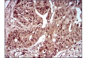 Immunohistochemical analysis of paraffin-embedded rectum cancer tissues using DAPK3 mouse mAb with DAB staining. (DAPK3 anticorps  (AA 28-161))