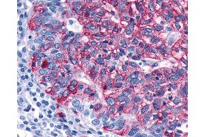 Anti-FZD3 / Frizzled 3 antibody IHC of human Ovary, Carcinoma. (FZD3 anticorps)