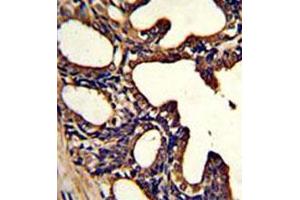Immunohistochemical staining of formalin-fixed and paraffin-embedded human prostate carcinoma reacted with LTF monoclonal antibody  at 1:50-1:100 dilution.