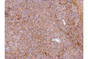 IHC-P Image Immunohistochemical analysis of paraffin-embedded PC13 xenograft, using PHGDH, antibody at 1:500 dilution.