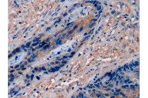 Detection of CD15 in Human Colorectal cancer Tissue using Polyclonal Antibody to Cluster Of Differentiation 15 (CD15)