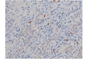 ABIN6267338 at 1/200 staining Human ganstric cancer tissue sections by IHC-P. (HSP90AB1 anticorps  (pSer254))