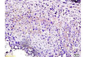 Formalin-fixed and paraffin embedded human breast cancer labeled with Anti-Arhgef2/GEF H1 Polyclonal Antibody, Unconjugated (ABIN705161) followed by conjugation to the secondary antibody and DAB staining (ARHGEF2 anticorps  (AA 21-120))