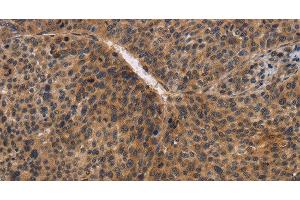 Immunohistochemistry of paraffin-embedded Human liver cancer using CDC34 Polyclonal Antibody at dilution of 1:50