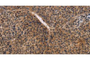Immunohistochemistry of paraffin-embedded Human liver cancer using CDC34 Polyclonal Antibody at dilution of 1:50 (CDC34 anticorps)