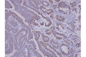 IHC-P Image Immunohistochemical analysis of paraffin-embedded human thyroid cancer, using SNX12, antibody at 1:100 dilution. (SNX12 anticorps  (C-Term))