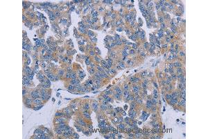 Immunohistochemistry of Human prostate cancer using P2RY2 Polyclonal Antibody at dilution of 1:40 (P2RY2 anticorps)