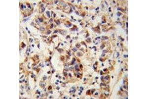 Immunohistochemistry analysis of human breast carcinoma (Formalin-fixed, Paraffin-embedded) using SPRR1B / Cornifin-B Antibody (C-term), followed by peroxidase-conjugated secondary antibody and DAB staining. (SPRR1B anticorps  (C-Term))