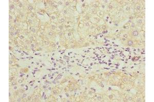 Immunohistochemistry of paraffin-embedded human liver cancer using ABIN7164691 at dilution of 1:100 (PDCD2L anticorps  (AA 1-358))