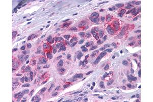 Anti-DUSP23 antibody IHC of human Skin, Melanoma. (DUSP23 anticorps  (Internal Region))
